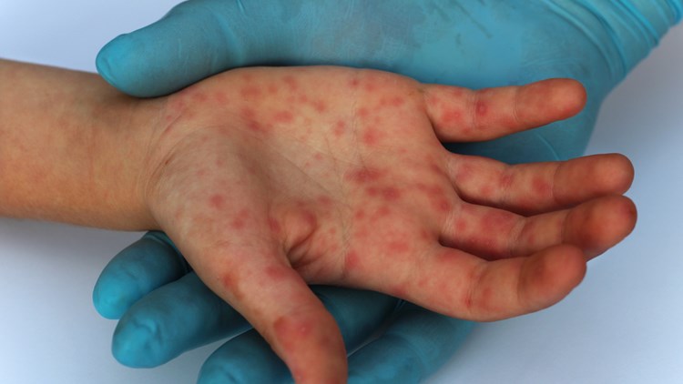 Επιδημία ιλαράς: Τι να προσέξουν παιδιά, έφηβοι και ενήλικες