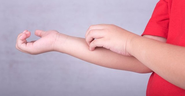 Φυσικές λύσεις για φαγούρα από κουνούπια